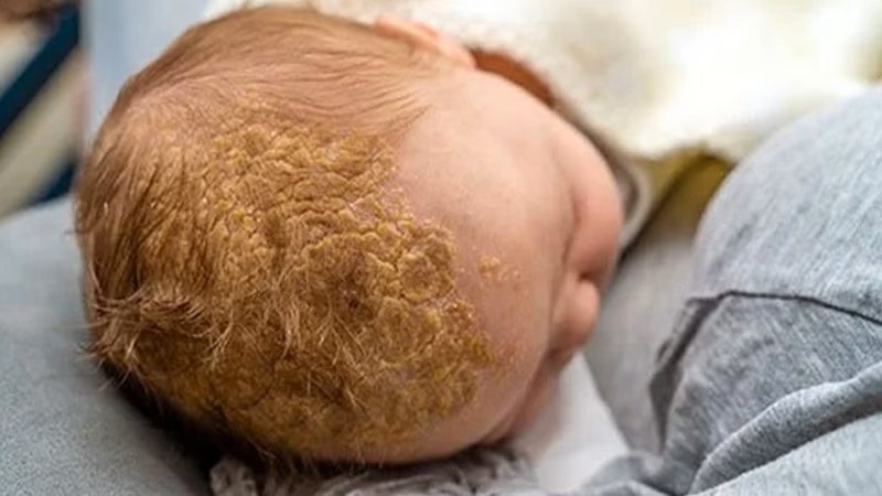 A baby with a hair blister on its headAI-generated content may be incorrect.